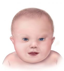 Bayi yang Terlahir dengan Sindroma Down