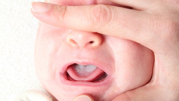 Bercak Putih pada Lidah dan Permukaan Mulut Bagian Dalam Bayi