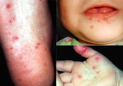 Gejala Flu Singapura atau Penyakit Tangan, Kaki, dan Mulut